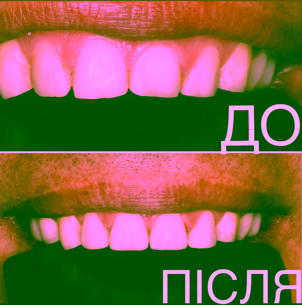 художня реставрація зубів