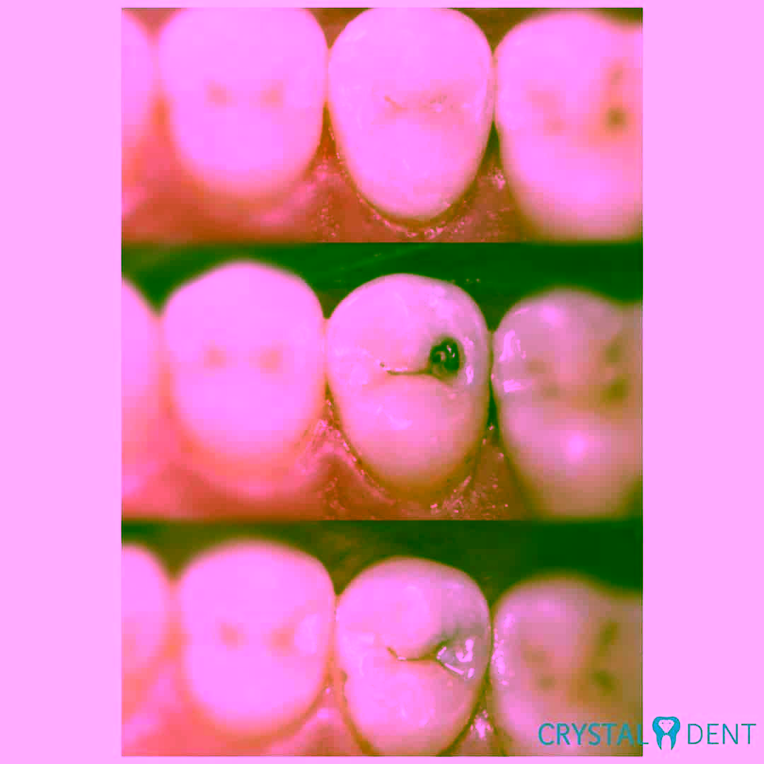 лечение кариеса голосеевский район фото до и после