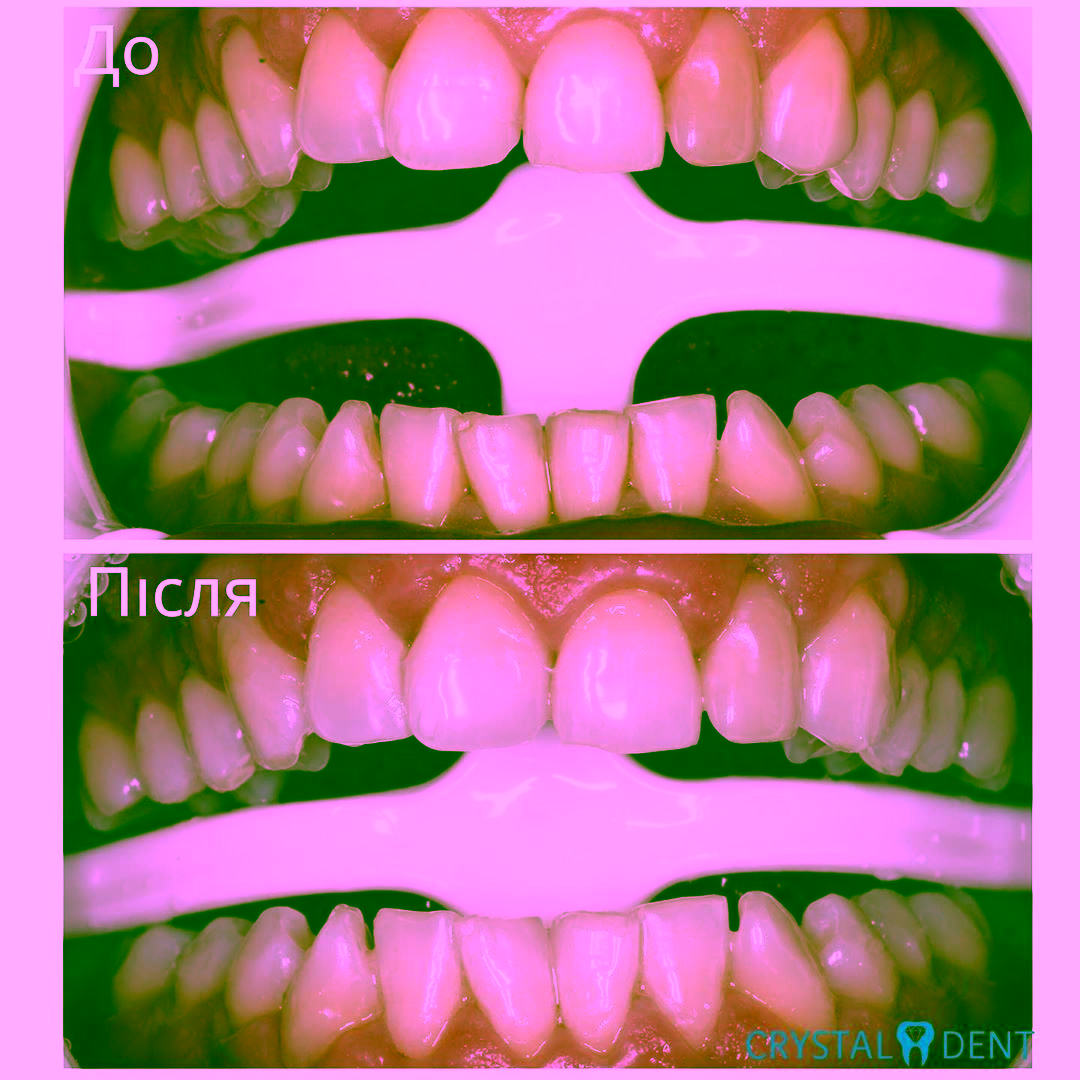 отбеливание зубов фото до и после