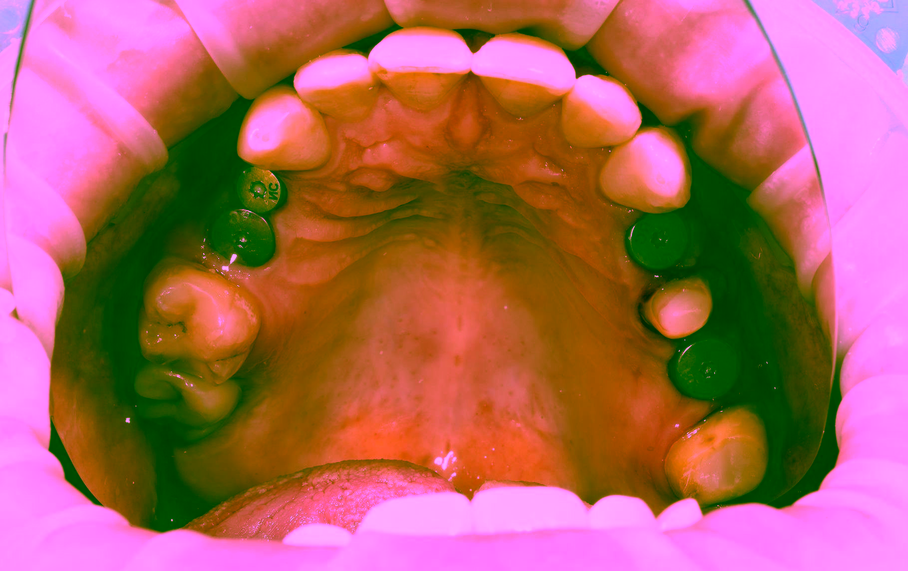 Протезирование зубов на имплантах