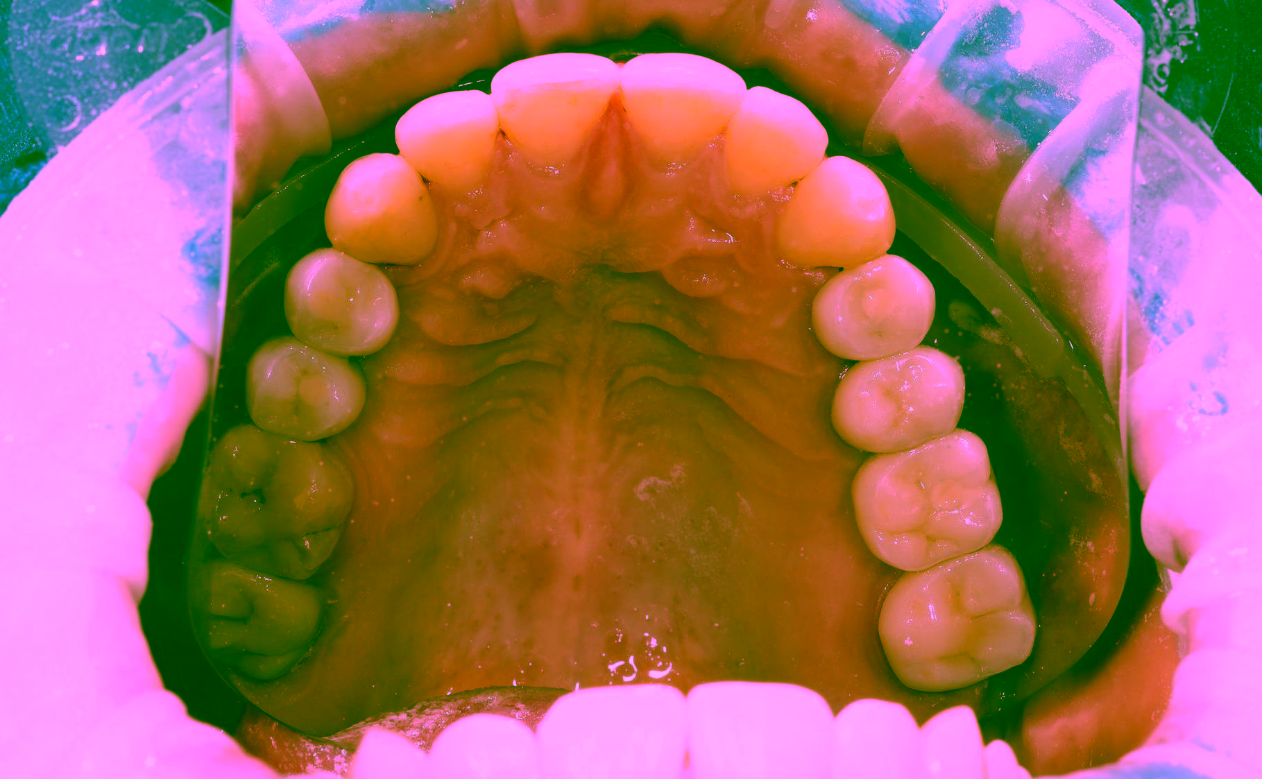 Протезирование зубов на имплантах