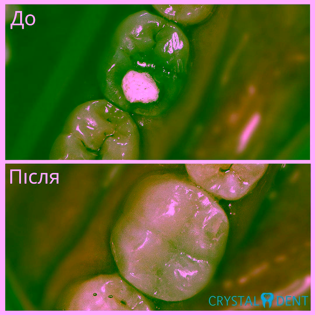 реставрация зубов киев голосеевский район фото до и после