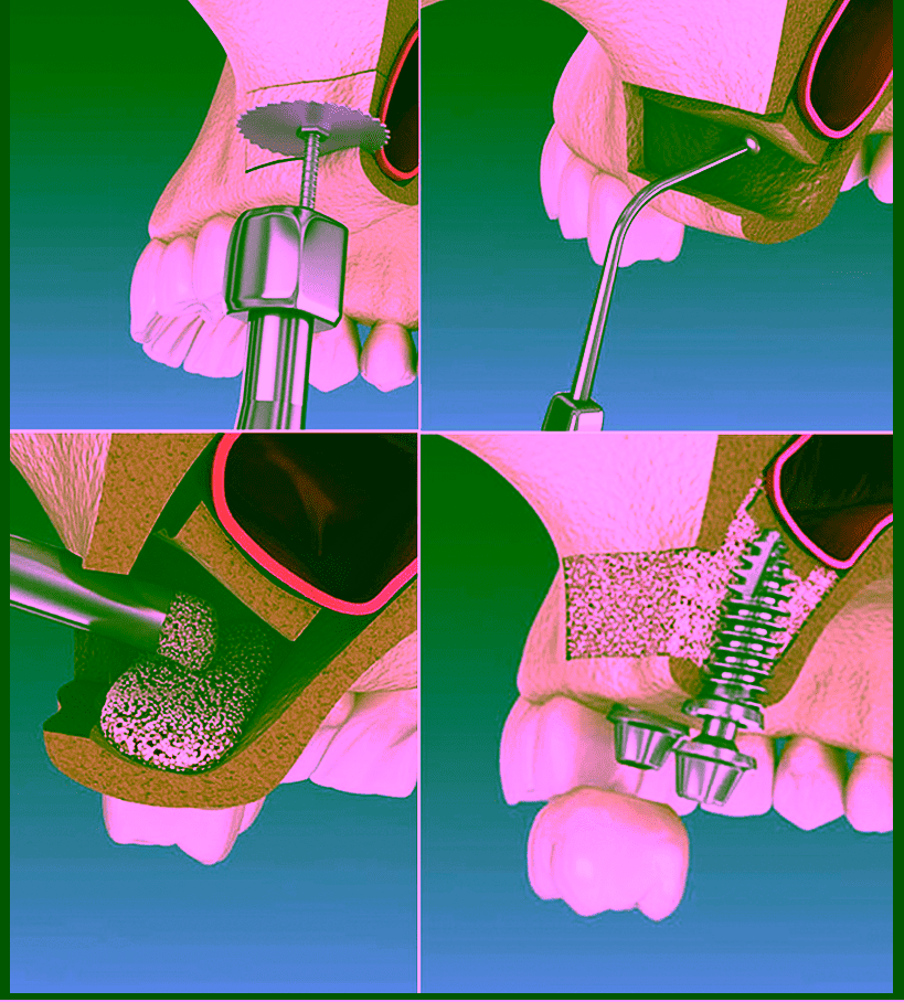 синус-лифтинг - киев