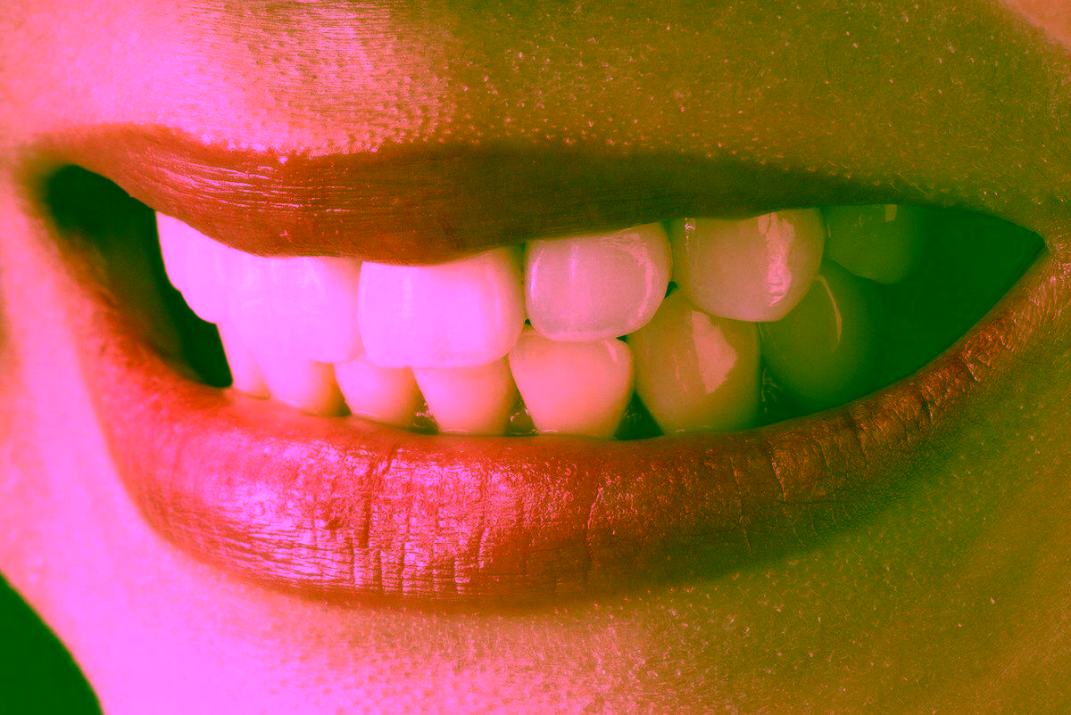 встановлення вінірів у Києві