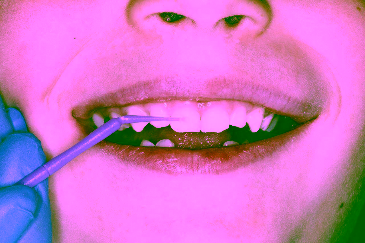 Фторування зубів