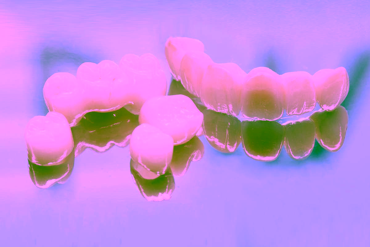 Цирконієва коронка - установка у Києві