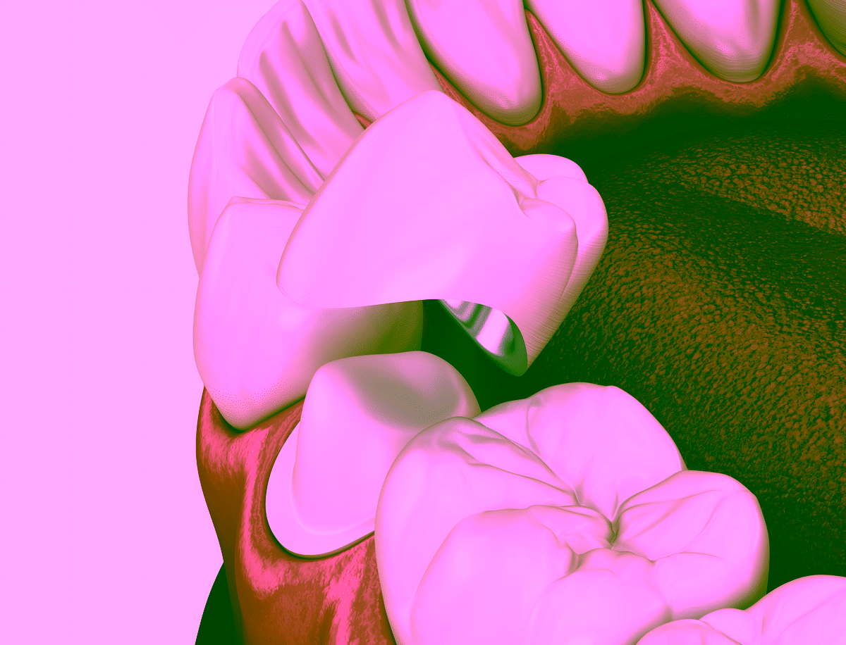 плюси і мінуси металокерамічних коронок