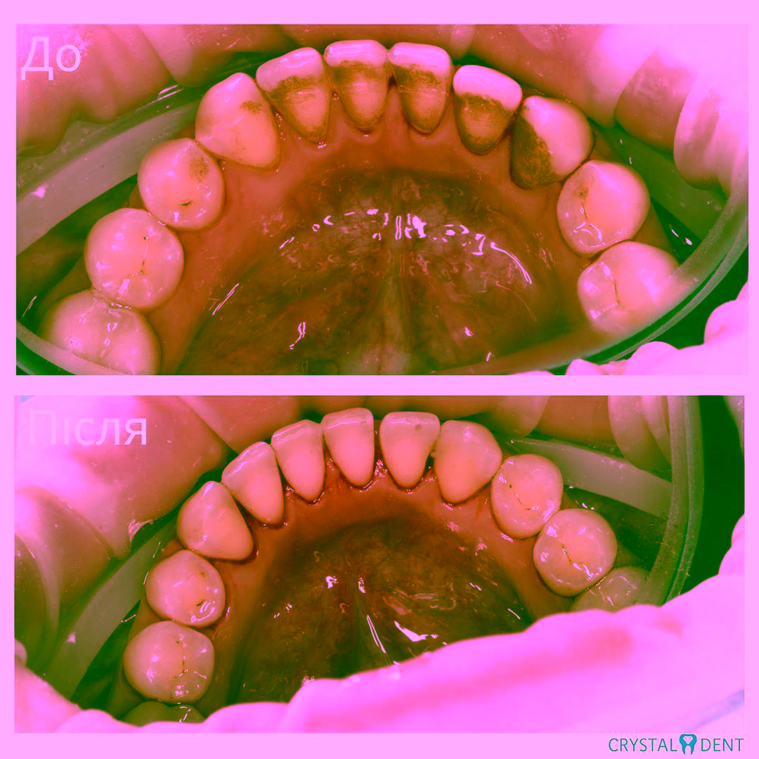зняття зубного каменя до та після