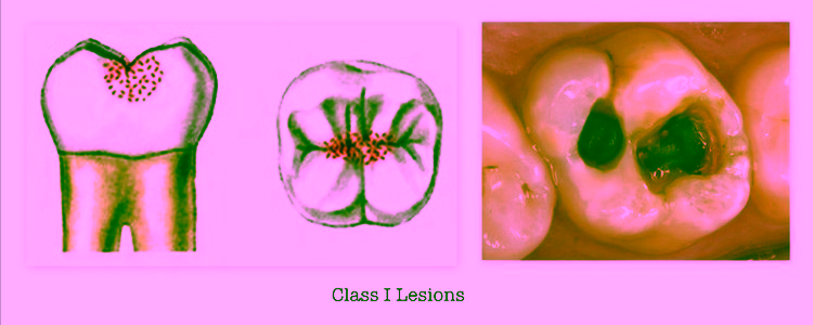 1 класс по Блэку - фото пример