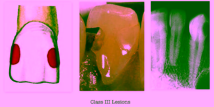 3 класс по Блэку - фото пример