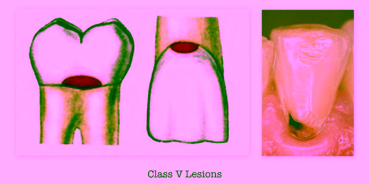 5 класс по Блэку - фото пример