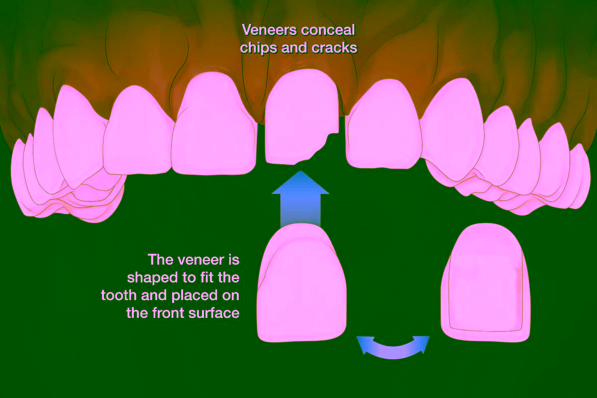 как ставят виниры - 3 этап - установка виниров