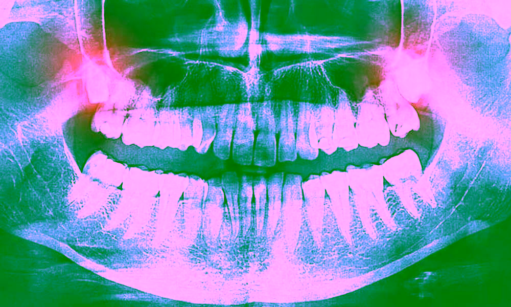 все чт онужно знать о зубах мудрости