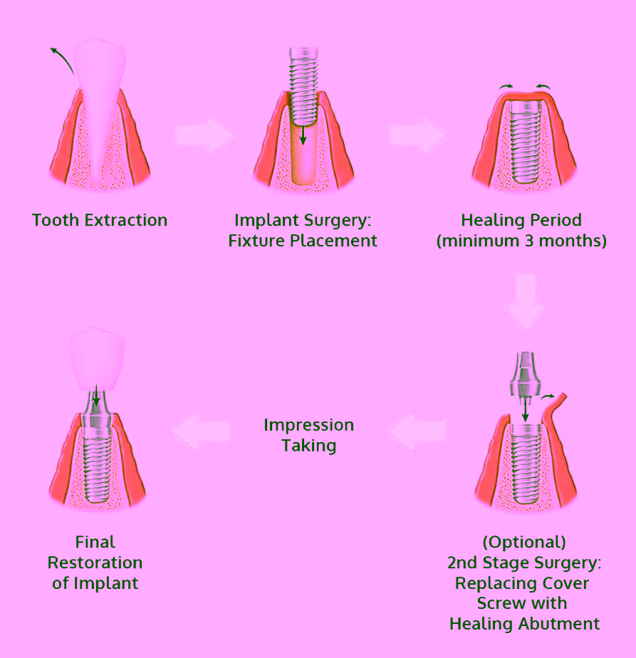 Stages of Dental Implantation