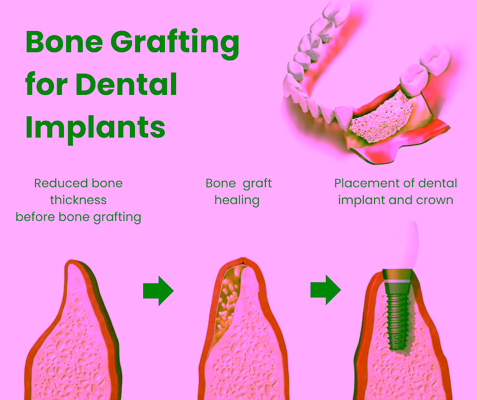 bone grafting