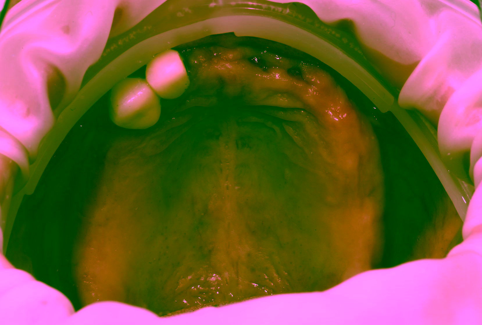 Нейлоновый протез на верхнюю челюсть фото