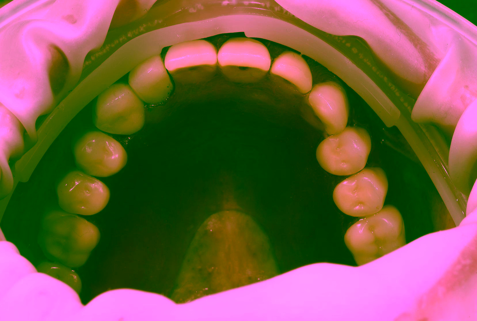 Нейлоновый протез на верхнюю челюсть фото