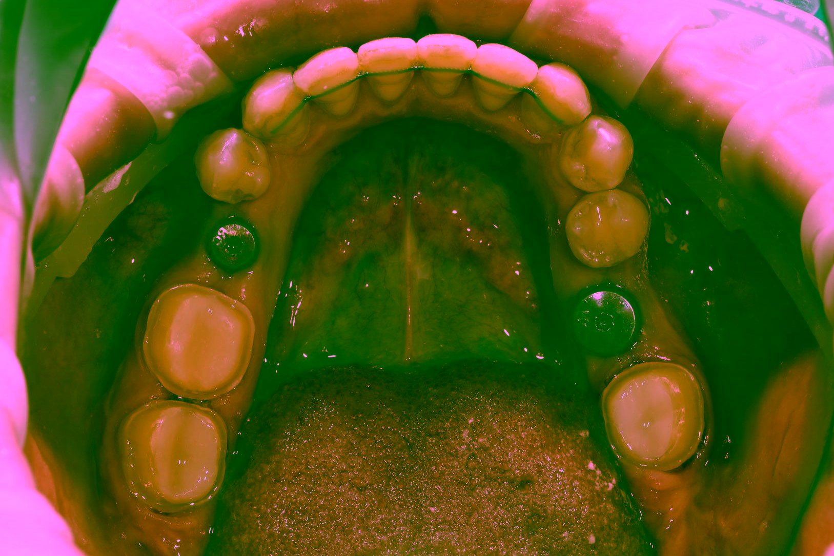 Сколько стоит имплантация зубов