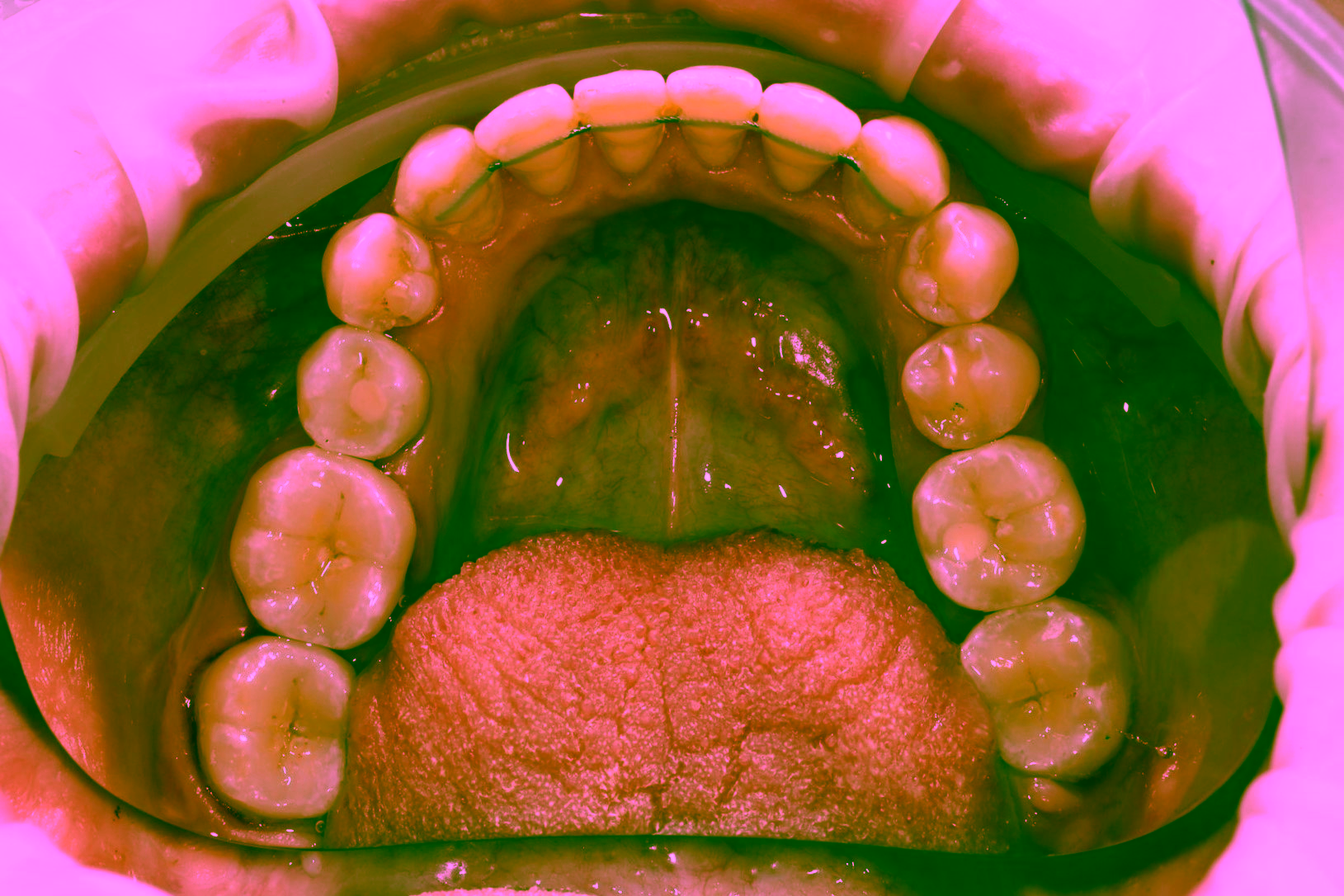 Сколько стоит имплантация зубов