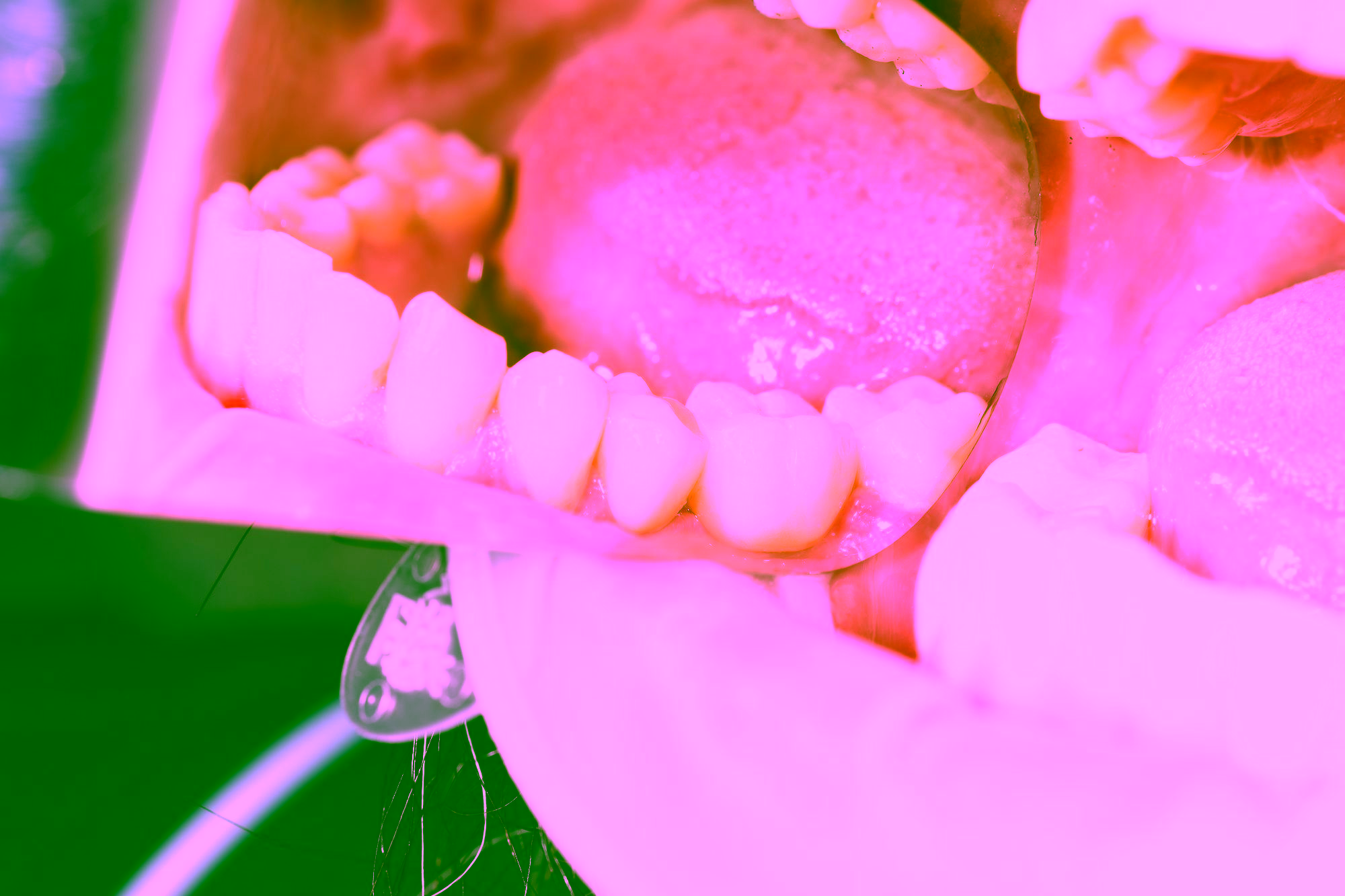 Сколько стоит имплантация зубов