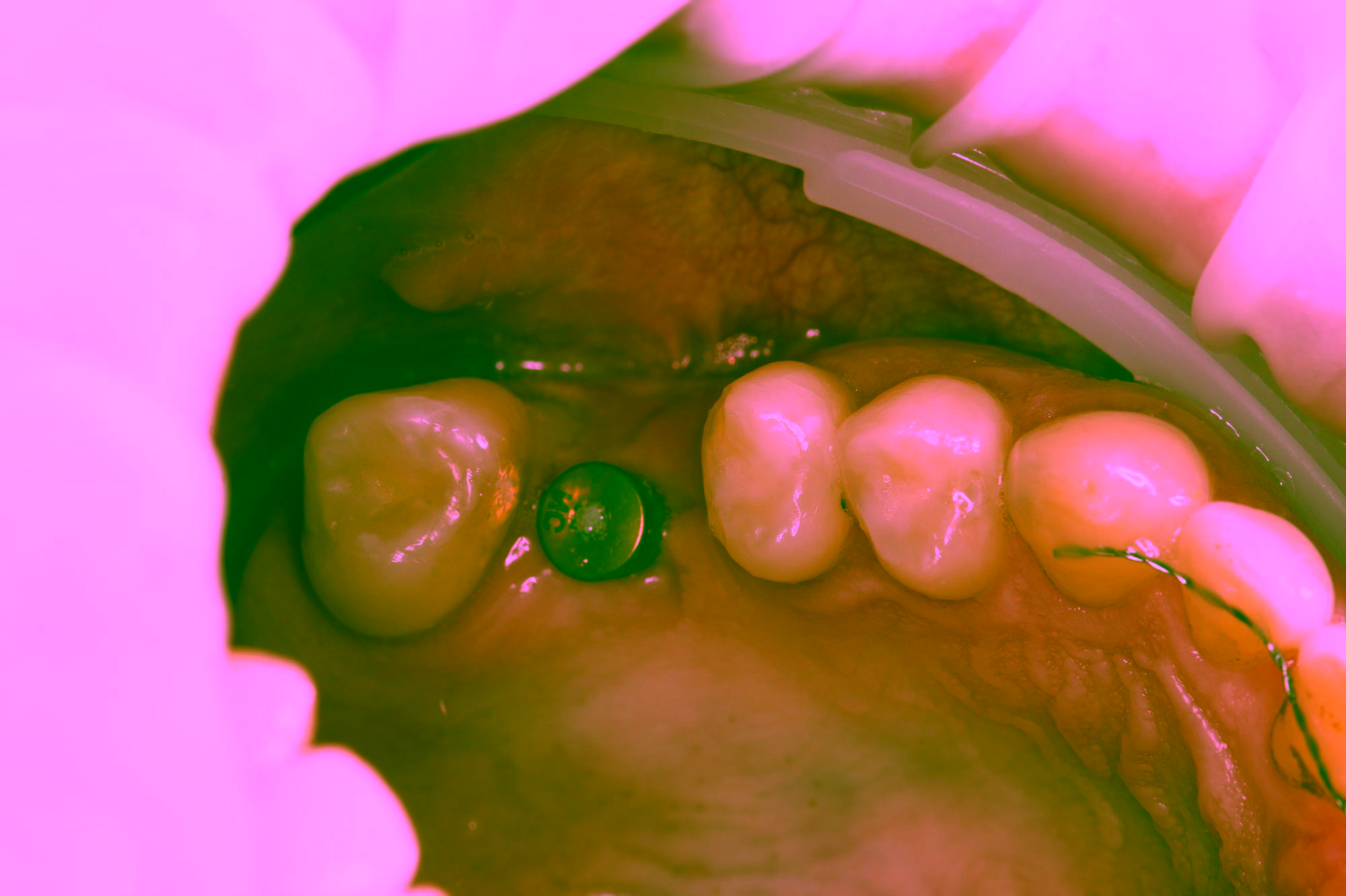 Сколько стоит имплантация зубов