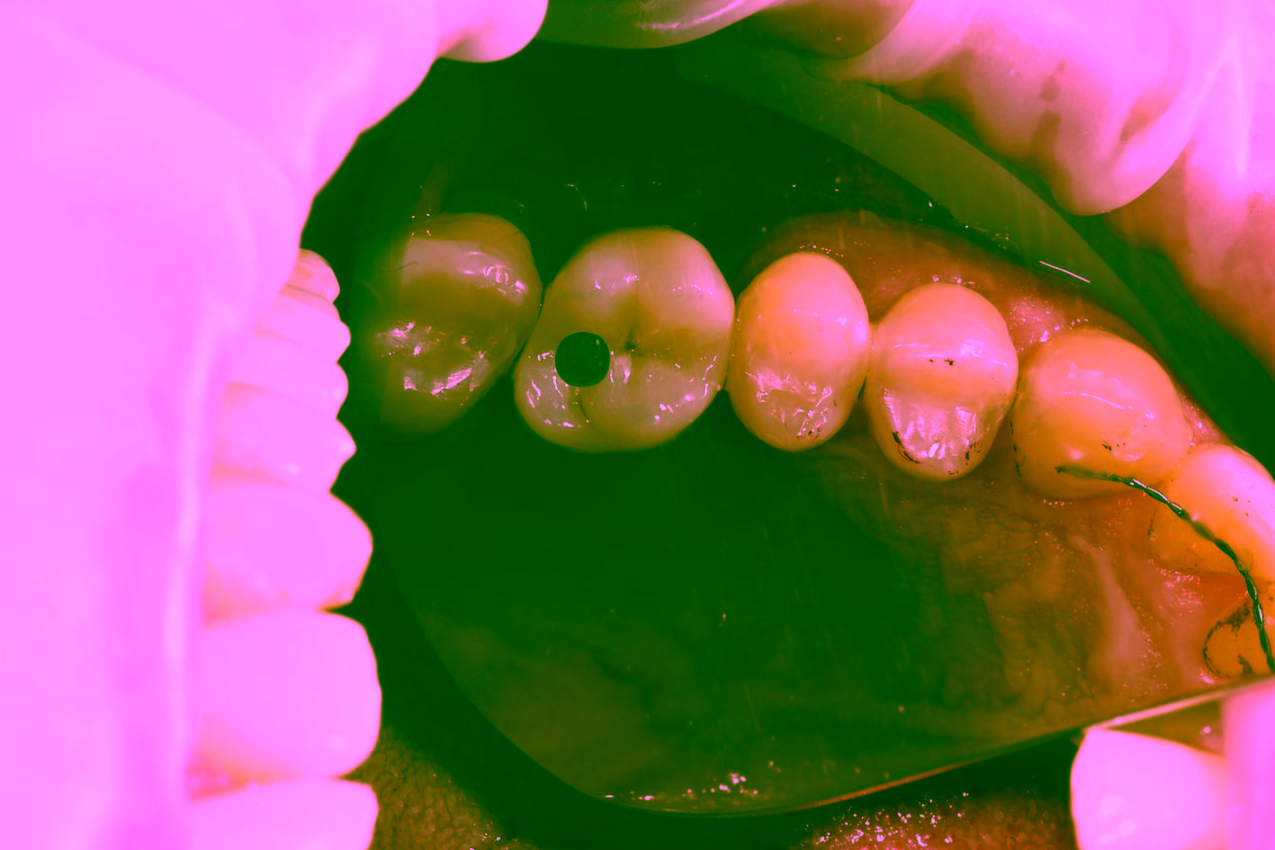 Сколько стоит имплантация зубов