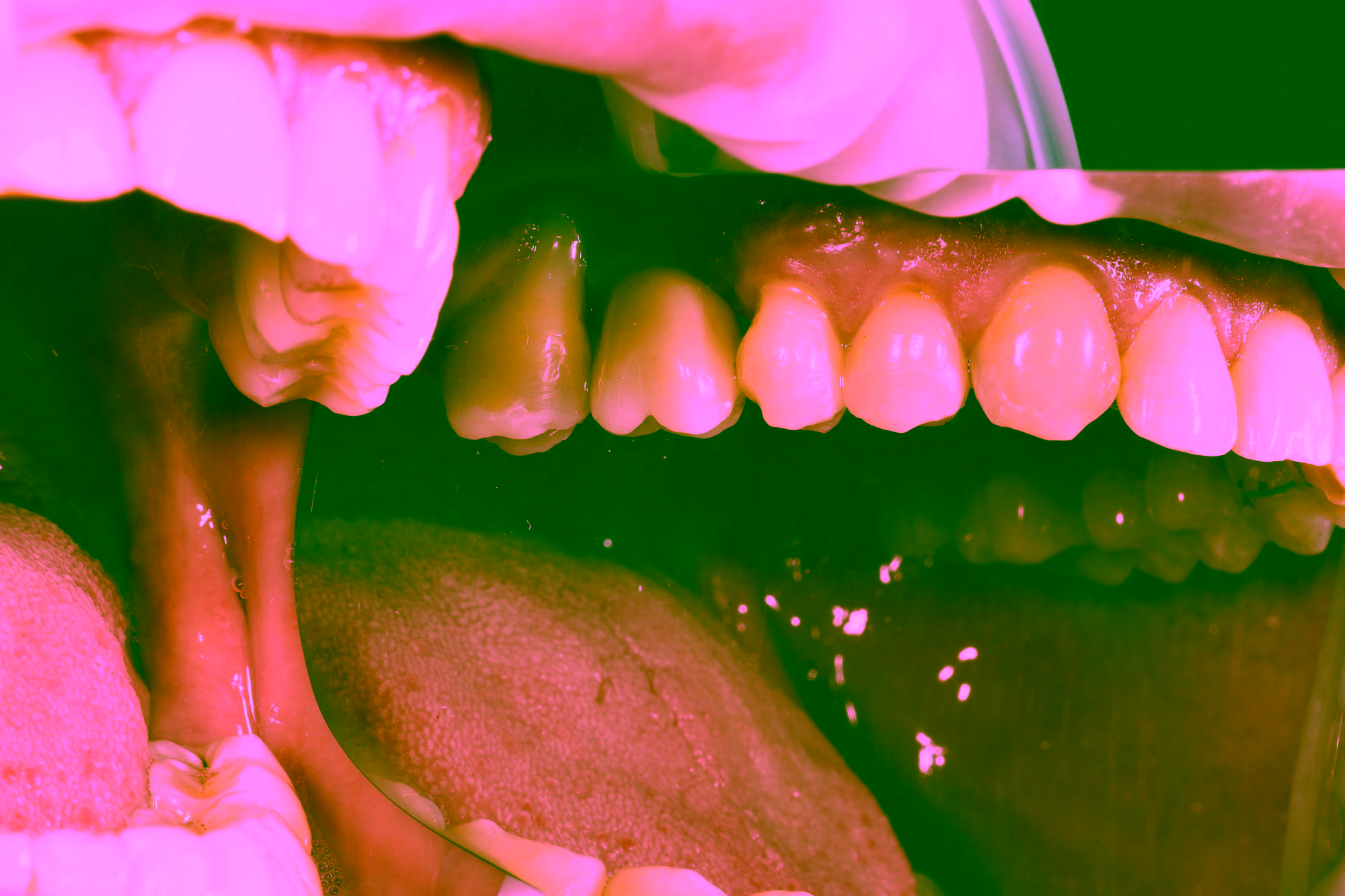 Сколько стоит имплантация зубов