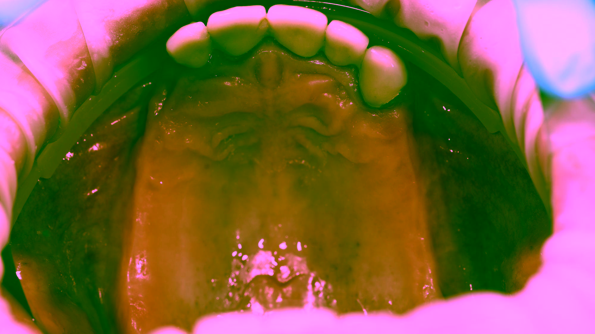 Бюгельный протез фото