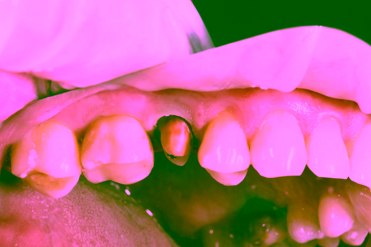 Коронки из диоксида циркония