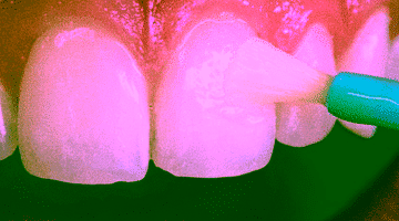 Фторирование зубов