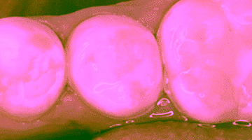 Герметизация фиссур