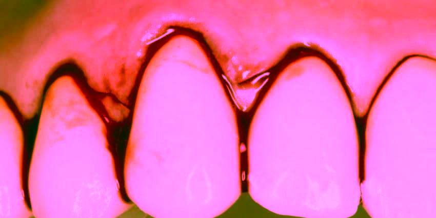 Кровоточат дёсны: причины, лечение и осложнения