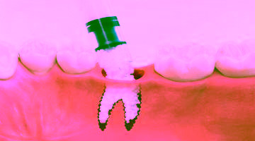 Атрофия костной ткани