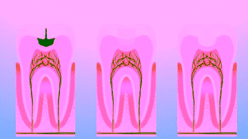 Пломбирование зубов