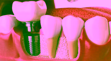 Костная пластика