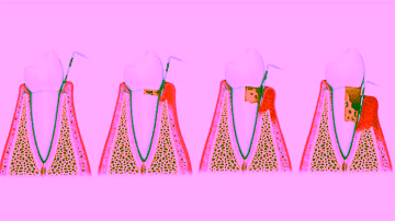 Закрытый кюретаж