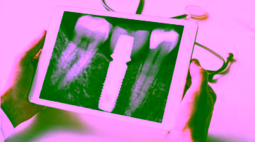 Протезирование зубов на имплантах