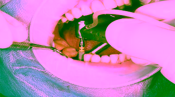 Имплантация