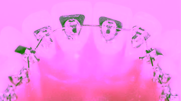 Лингвальные брекеты