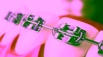 Металлические брекеты