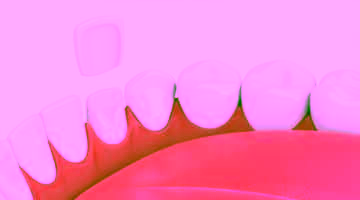 Микропротезирование