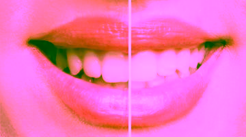 Отбеливание зубов