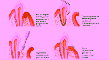 Открытый кюретаж