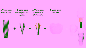 Этапы имплантации зубов