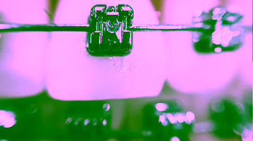 Самолигирующие брекеты