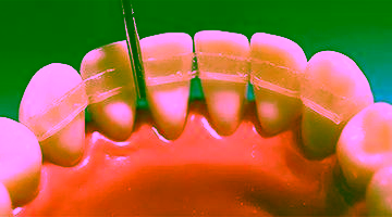 Шинирование зубов