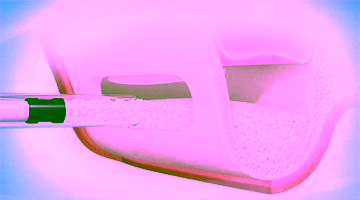 Синус-лифтинг