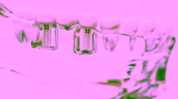 Системы имплантов