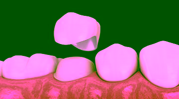 Безметалловая керамика