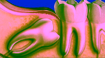 Удаление ретенированных зубов